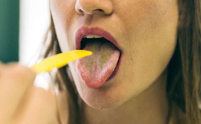 Raisons pour lesquelles un revêtement vert se forme sur la langue et comment y faire face