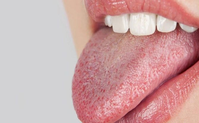 Que faire en cas de brûlure de la langue - comment traiter et soulager la douleur