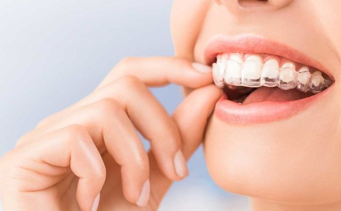 Comment aligner les dents avant et à mâcher sans croisillons chez les enfants et les adultes