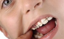 Bretelles sur les dents: ce qui est nécessaire, les types, l'installation