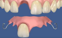 Types de fausses dents, quelles dents sont mieux à insérer