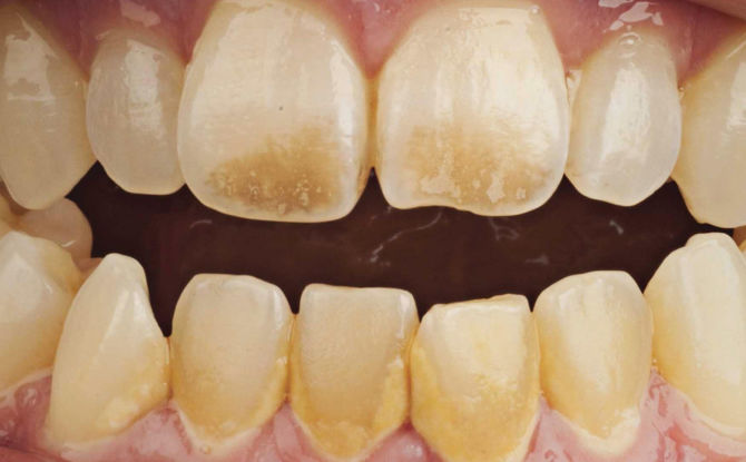 Comment et comment nettoyer les dents de la plaque à la maison