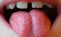 Pourquoi des boutons rouges et blancs et des boutons apparaissent sur la langue d'un enfant