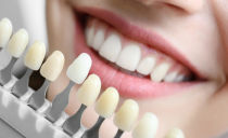 Placages sur les dents: qu'est-ce que c'est