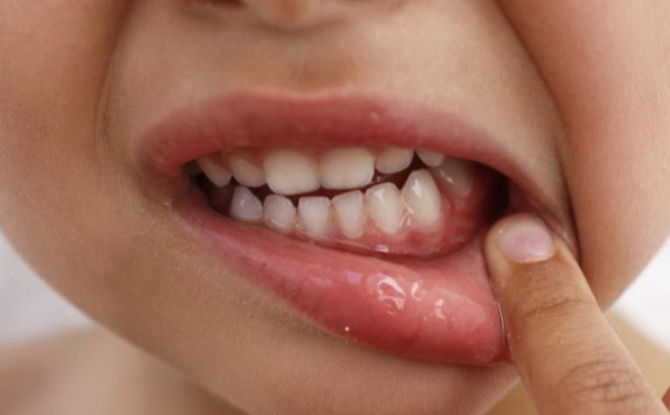 Gingivite chez les enfants et les nourrissons: causes, symptômes, traitement