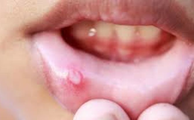 Inflammation de la muqueuse buccale: causes et traitement