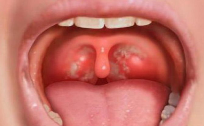 Points blancs sur les amygdales et les amygdales dans la gorge chez les enfants et les adultes: causes et traitement