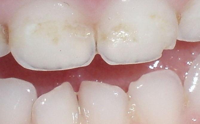 Hypoplasie de l'émail: causes, symptômes, formes, méthodes de diagnostic et de traitement