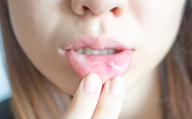 Inflammation de la muqueuse buccale: causes et traitement