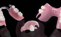 Prothèses amovibles et non amovibles avec absence partielle de dents: types et photos