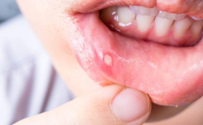 Stomatite: symptômes, causes, traitement et prévention