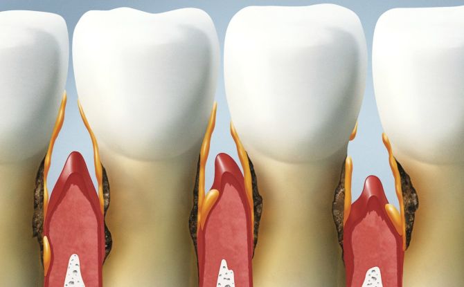Causes, symptômes et traitement de la parodontite
