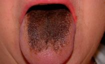 Plaque brune sur la langue chez les adultes et les enfants: causes et signification