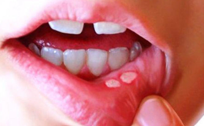Causes, symptômes et traitement de la stomatite aphteuse