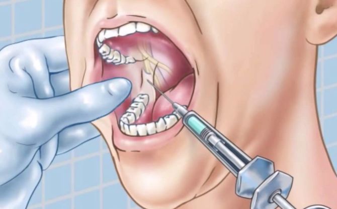 Anesthésie par conduction en dentisterie - qu'est-ce que c'est, types