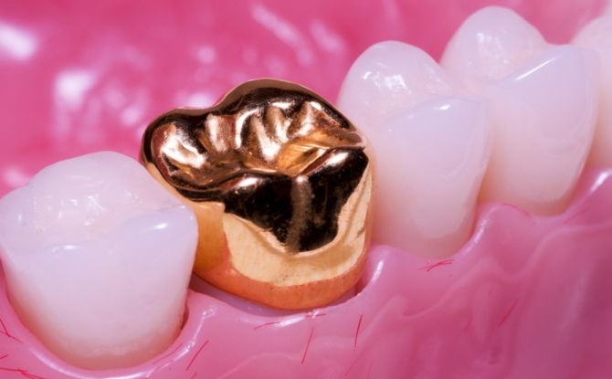 Types de couronnes sur les dents, quelles couronnes sont mieux placées sur le devant et les dents à mâcher