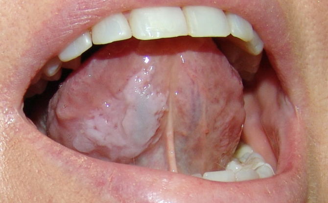 Leucoplasie de la muqueuse buccale et de la langue: formes, causes, symptômes, traitement