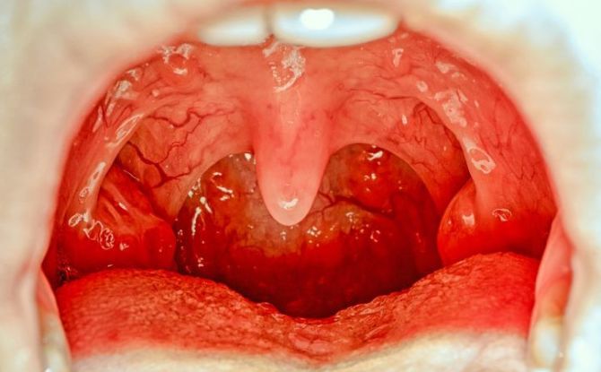 Inflammation des amygdales et des amygdales dans la gorge chez l'adulte et l'enfant: symptômes, causes, traitement, photo