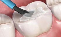 Sceller les fissures des dents chez les enfants et les adultes: quels sont ces avantages et inconvénients?