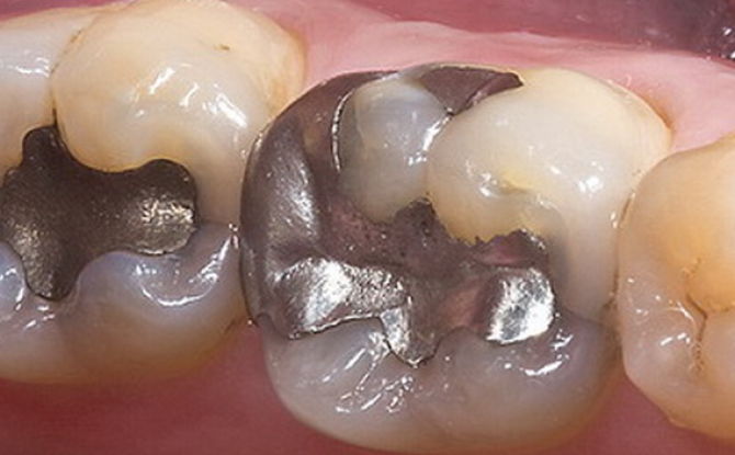 Combien ne peut-on pas manger après le remplissage des dents et pourquoi
