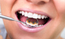 Comment mettre un appareil dentaire sur les dents: types, conditions de port et d'installation