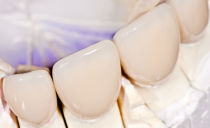 Couronnes sur les dents de devant: types de fabrication et prix de revient