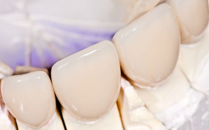 Couronnes sur les dents de devant: types de fabrication et prix de revient