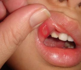 Afta dans la bouche de l'enfant