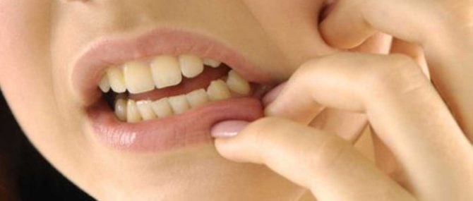 Démangeaisons des dents