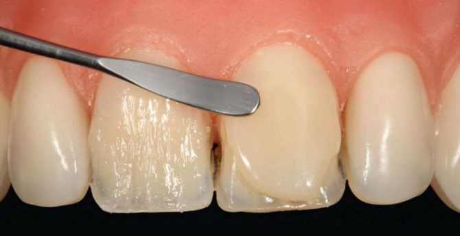 Placage composite