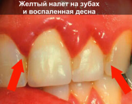 Plaque sur les dents et les gencives douloureuses