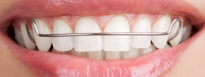 Plaques d'alignement des dents