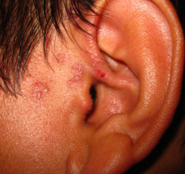 Signes de boutons de fièvre dans l'oreille