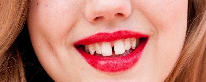 Écart entre les dents de devant