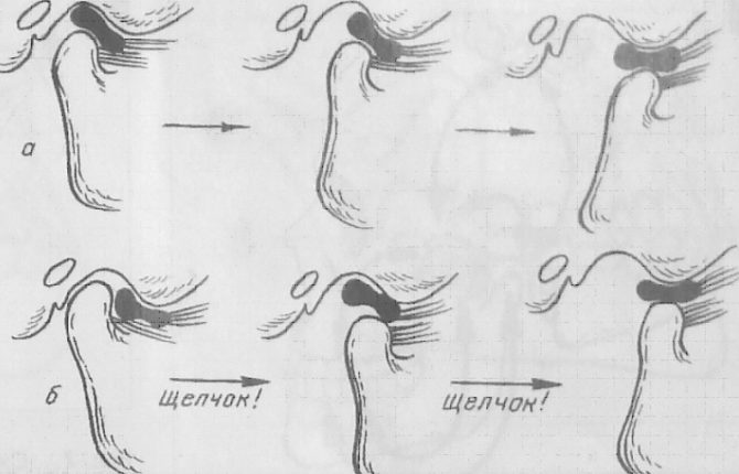 Le schéma de la formation d'un clic au moment de la luxation de la mâchoire