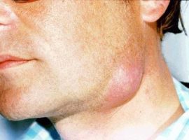 Inflammation sévère du ganglion lymphatique sous-mandibulaire dans le cou