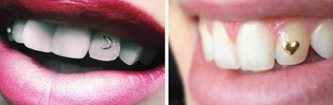 Strass sur les dents
