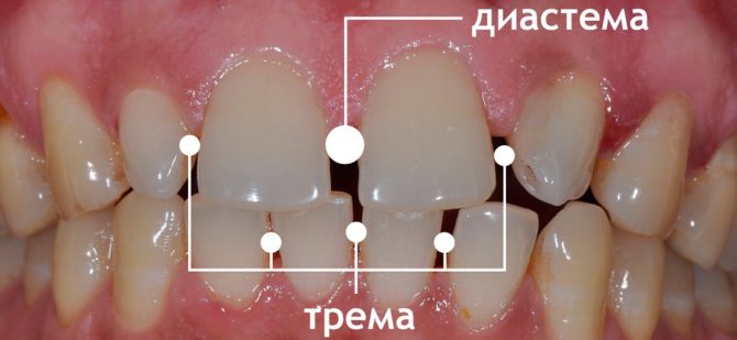 Types d'écarts entre les dents