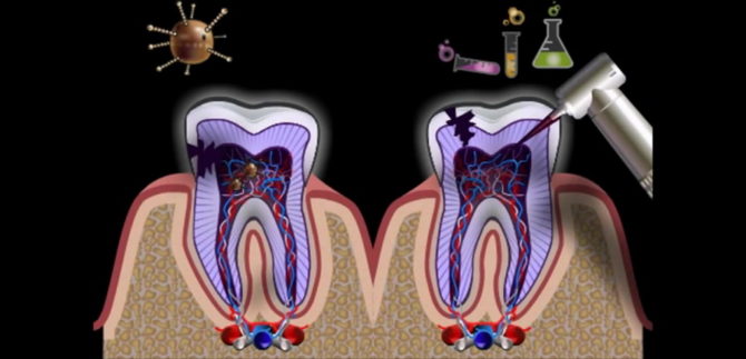 Inflammation des racines des dents