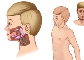 Ganglions lymphatiques enflammés avec oreillons.png