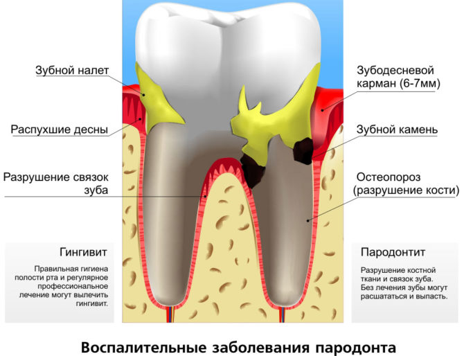 Maladie parodontale inflammatoire