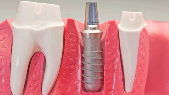 Restauration dentaire avec implant