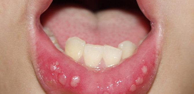 Plaies dans la bouche