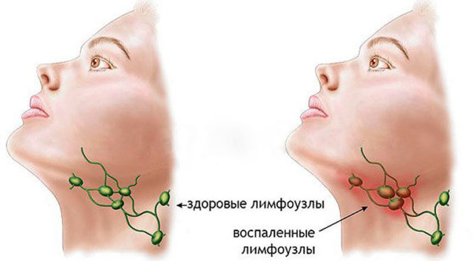 Ganglions lymphatiques sains et enflammés