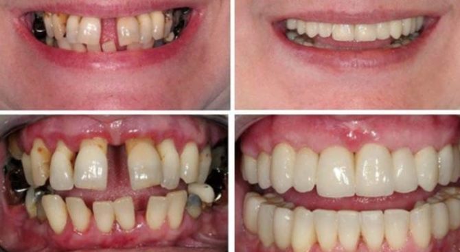 Dents avant et après attelle avec couronnes céramique-métal