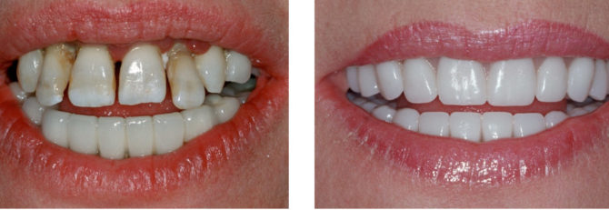 Dents avant et après la pose des facettes