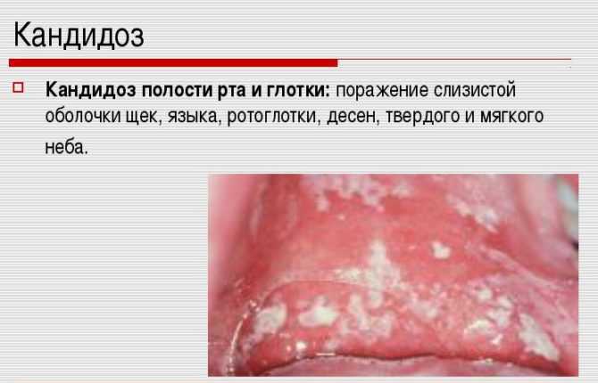 Candidose dans la bouche