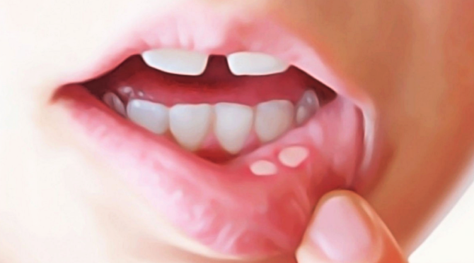 Manifestations externes de stomatite aphteuse